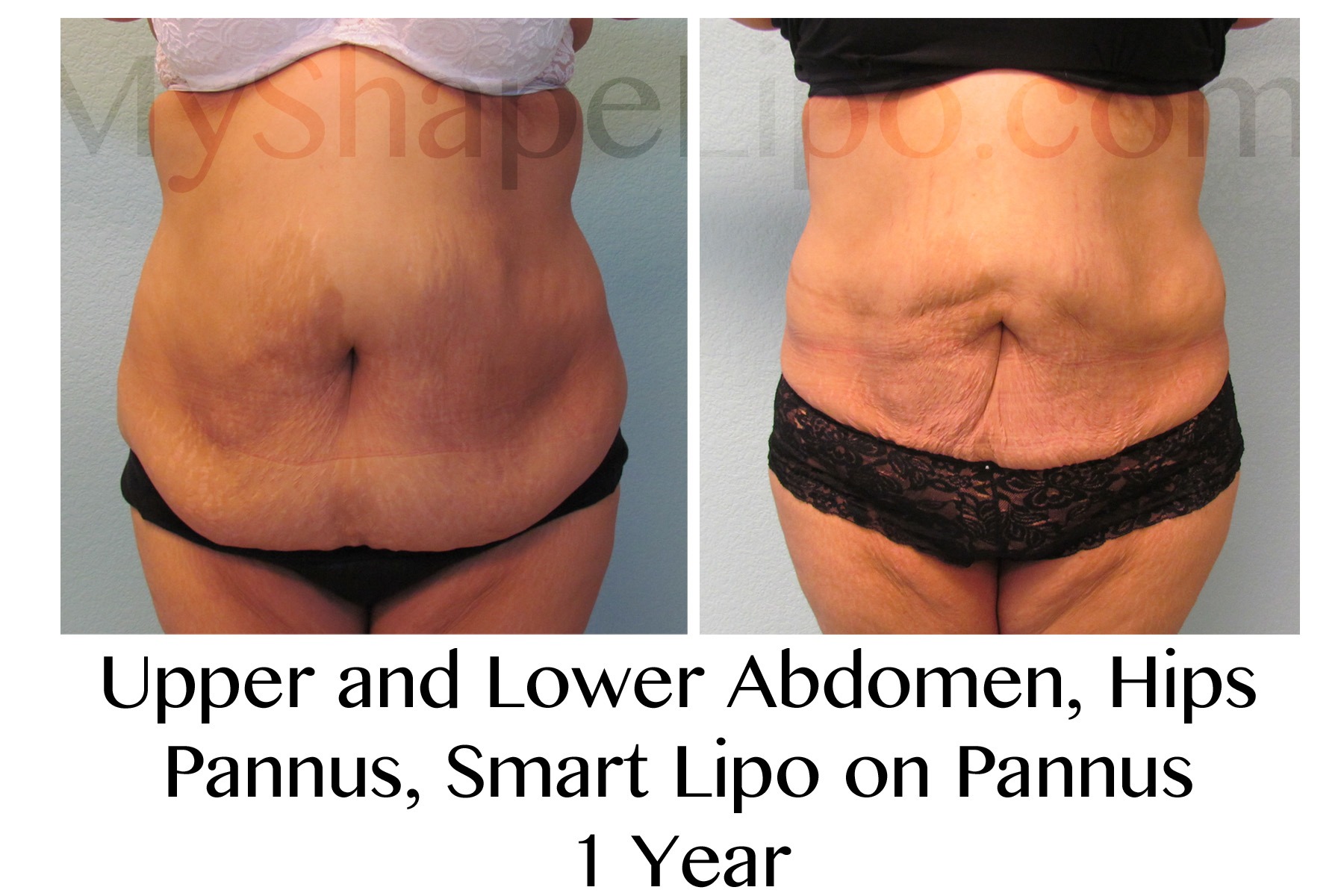 Myshape Lipo Announces Their Fight Against Obesity And Promotes Large Volume Liposuction 3027